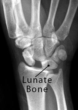 Lunate Bone: Definition, Location, Anatomy, Function, Diagram | The
