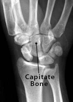 Capitate Bone Definition, Location, Anatomy, Diagram