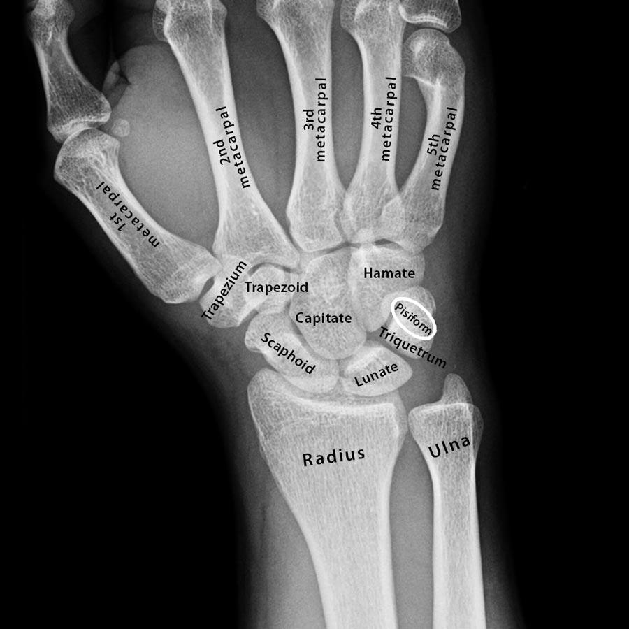 Carpal Bones (Wrist Bones): Definition, Names, Anatomy, Diagram