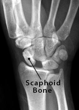 Scaphoid Bone Definition, Location, Anatomy, Diagram