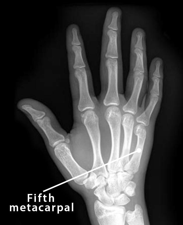 Fifth Metacarpal: Definition, Location, Anatomy, Diagram