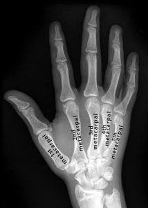 Metacarpals: Definition, Location, Anatomy, Function, Diagram