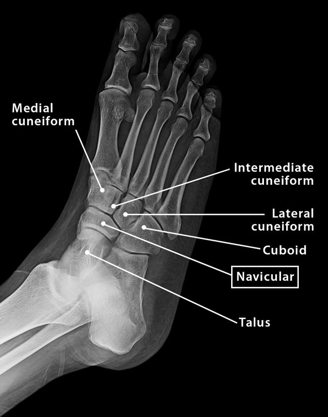 Navicular bone